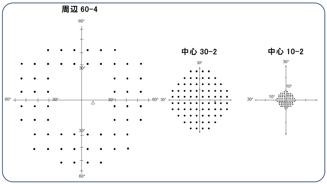 ハンフリー視野検査周辺60-4の計測方法と結果の見方を優しく解説【眼科医・視能訓練士・看護師向けの解説】